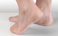 Dry and cracked soles of feet on gray background, foot with dry heels, cracked skin heel of foot with bad skin is covered with