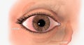 Dry eye is a common condition that results from poor nourishment of the eye