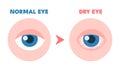 Dry eyes. Healthy unhealthy red eye, driing astonished redness irritated surface eyeball, conjunctivitis glaucoma