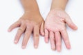 Dry hands, peel, Contact dermatitis, fungal infections, Skin inf Royalty Free Stock Photo