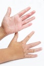 Dry hands, peel, Contact dermatitis, fungal infections, Skin inf Royalty Free Stock Photo