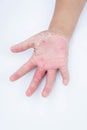 Dry hands, peel, Contact dermatitis, fungal infections, Skin inf