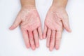 The Dry hands, peel, Contact dermatitis, fungal infections, Skin inf