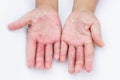 THE Dry hands, peel, Contact dermatitis, fungal infections, Skin inf Royalty Free Stock Photo