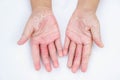 The Dry hands, peel, Contact dermatitis, fungal infections, Skin inf Royalty Free Stock Photo