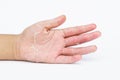 The Dry hands, peel, Contact dermatitis, fungal infections, Skin inf Royalty Free Stock Photo