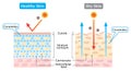 Dry and healthy skin layer illustration. skin care concept