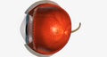 Dry macular degeneration is a type of age-related vision impairment that results in blurred or lost central vision