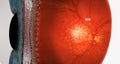 Dry macular degeneration is a type of age-related vision impairment that results in blurred or lost central vision