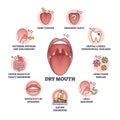 Dry mouth or xerostomia as salivary glands saliva problem outline diagram