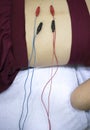 Dry needling EPI needle