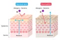 Atopic dermatitis eczema dry and normal skin cell layer  illustration. Before and after. Healthy and beauty skin care concept Royalty Free Stock Photo