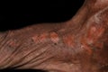 Dry and scaly skin, and abrasions in foot. Dermatitis foot