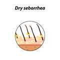 Dry seborrhea skin and hair. Dandruff, seborrheic dermatitis. Baldness, hair growth, baldness. Anatomical structure