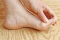 Dry skin and cornea on toes and heel of a woman Royalty Free Stock Photo