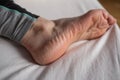 Skin disease in dry winter, dehydrated skin on the heels of female feet