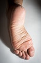 Dry skin on heel,health care. Royalty Free Stock Photo