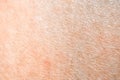 Dry skin or ichthyosis texture detail. Extreme close up macro shot dehydration skin. Royalty Free Stock Photo