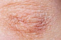 Dry skin or ichthyosis texture detail. Extreme close up macro shot dehydration skin. Royalty Free Stock Photo