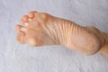 Dry skin, plantar callosity and flakes on the female feet