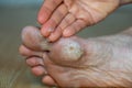 Dry skin, plantar callosity and flakes on the female feet sole close up. Hand applying medicated ointment to sole