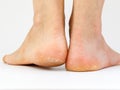 Dry skin, plantar callosity and flakes on female heel and feet sole close up Royalty Free Stock Photo