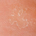 Dry skin texture Royalty Free Stock Photo