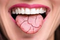 Dry Tongue Pain And Cracks