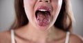 Dry Tongue Pain And Cracks