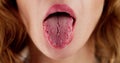 Dry Tongue Pain And Cracks