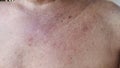 Dryness skin infections, allergic reactions and rash on the body, scratch itchy