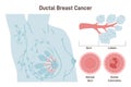Ductal carcinoma. Detailed breast medical anatomy with lactiferous