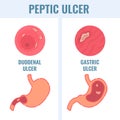 Duodenal and gastric types of peptic ulcer stomach disease