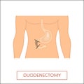 Duodenectomy