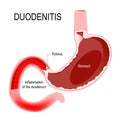 Duodenitis. Stomach and duodenum with inflammation. Human anatomy.