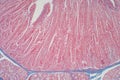 Duodenum biopsy from the pathology of  small intestine Royalty Free Stock Photo