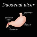 Duodenum ulcer affected. Duodenal ulcer. Vector illustration on a black background