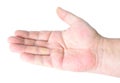 Dupuytren`s contracture, also called Dupuytren`s disease, Morbus Dupuytren, Viking disease, and Celtic hand. On white background