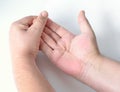 Dupuytren`s contracture, also called Dupuytren`s disease, Morbus Dupuytren, Viking disease, and Celtic hand. Inspection