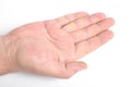 Dupuytren`s contracture, also called Dupuytren`s disease, Morbus Dupuytren, Viking disease, and Celtic hand. On white background