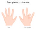 Dupuytren`s contracture. Comparison and difference of a healthy hand and Dupuytren`s disease in left hand