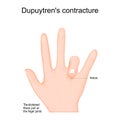 Dupuytren`s contracture. Dupuytren`s disease in left hand Royalty Free Stock Photo