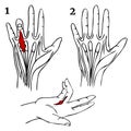 Dupuytren\'s contracture. Infographics of palms before and after surgery.