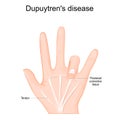 Dupuytrens disease. Human hand with Tendons