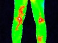 DW Legs thermography