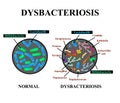 Dysbacteriosis intestine. Lactobacillus, Bifidobacteria, Streptococcus, Staphylococcus, E. coli, Aspergyllus mushrooms, Candida