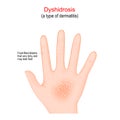 Dyshidrosis. type of dermatitis with itchy blisters on the palms