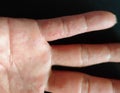 Dyshidrotic Eczema is an allergic skin condition.