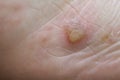 Dyshidrotic eczema on the foot. Blister dermatitis. Close-up shot