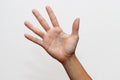 Dyshidrotic eczema skin disease on palm